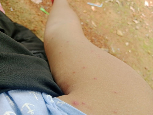 ตุ่ม ขึ้นเต็มตัว