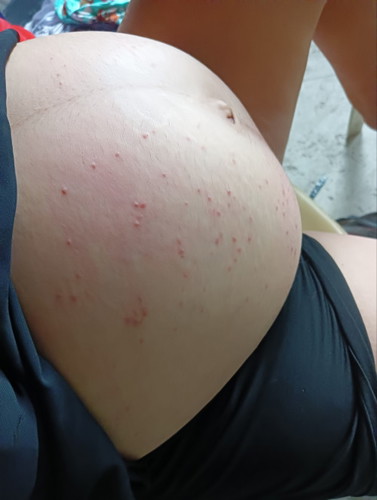 Rashes or allergy