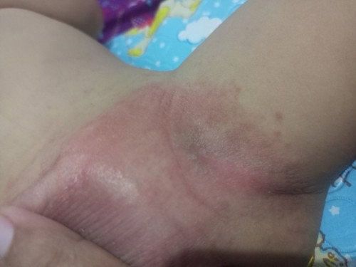 Ruam popok atau bukan?