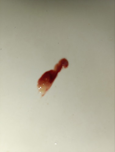 MUCUS PLUG