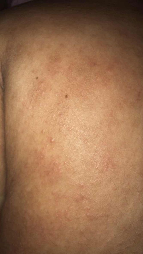 Gatal-gatal setelah lahiran