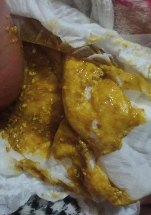 ให้ลูกกินนมผงวันแรกสลับกับนมแม่ ถ่าย1ครั้งเป็นแบบนี้ผิดปกติไหมคะแม่ๆ