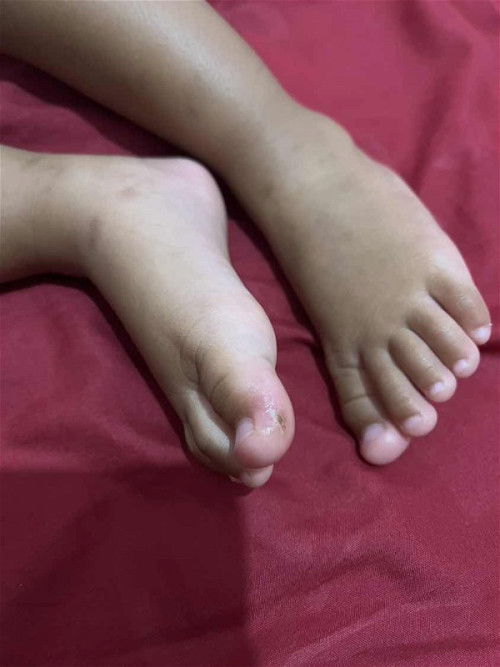 Kulit kering pada bayi