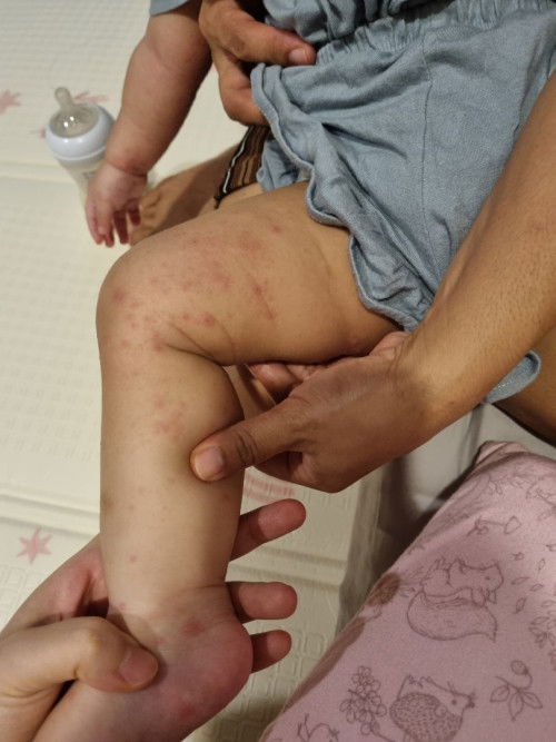 Baby dengan ezcema kena HFMD / flu singapore