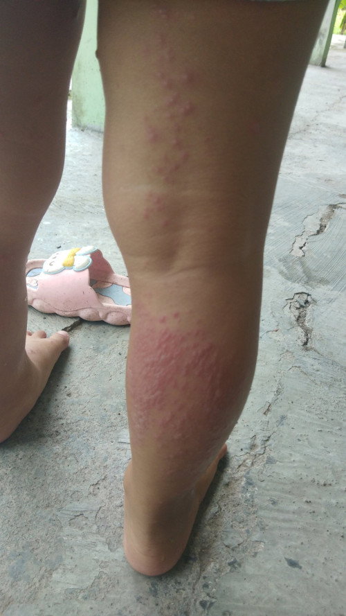 Obat yg ampuh buat kek gni kak. Kasian. Untuk umur 2thun