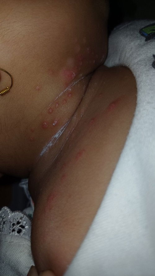 Obat untuk leher bayi