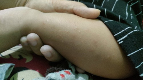 Bintik merah di betis bayi 6 bulan