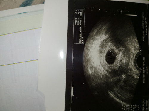 Usia 8week Usg Janin tidak kelihatan