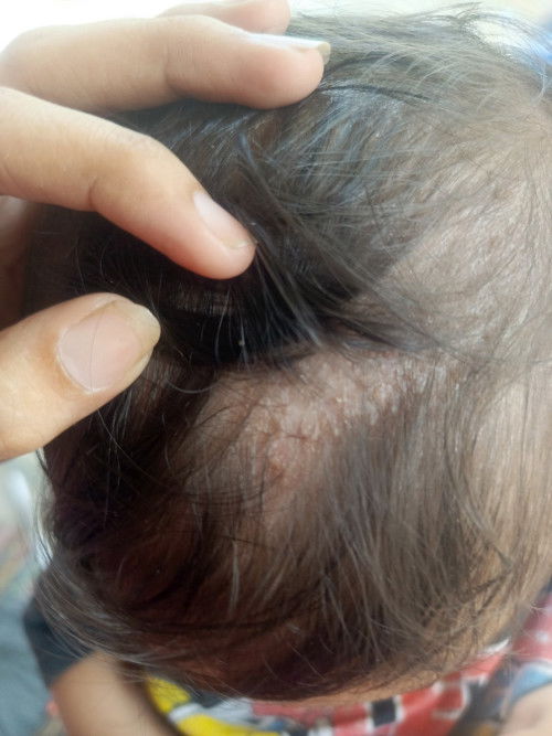 Kepala bintik bintik