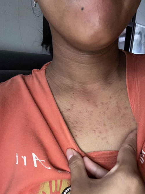 Jerawat Punggung dan leher