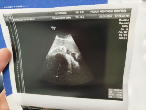 แม่เป็นเบาหวานก่อนตั้งครรภ์