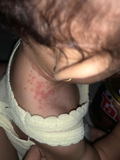 Bagian leher memerah