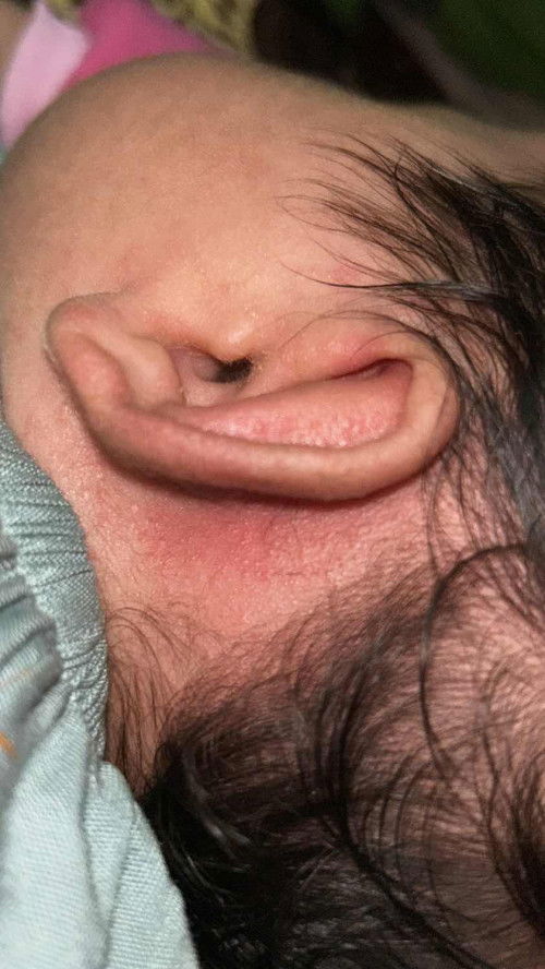 Telinga bayi 1 bulan berkerak