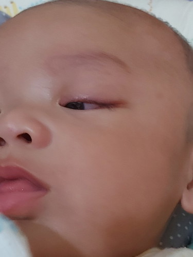 Mata merah pada bayi 4 bulan
