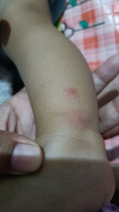 Bentol merah dibeberapa bagian