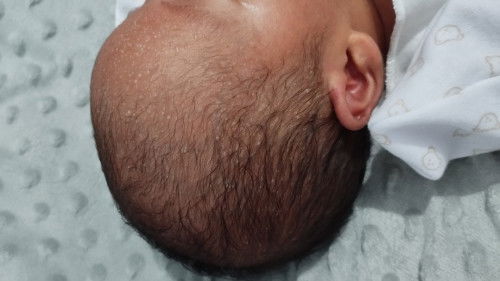 Kepala bayi bentol berisi air