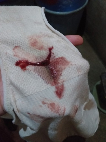 Bloody Discharge