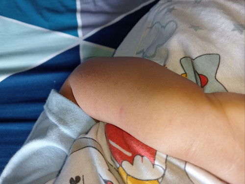 Kulit bayi kayak bruntusan