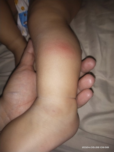 Insect bites