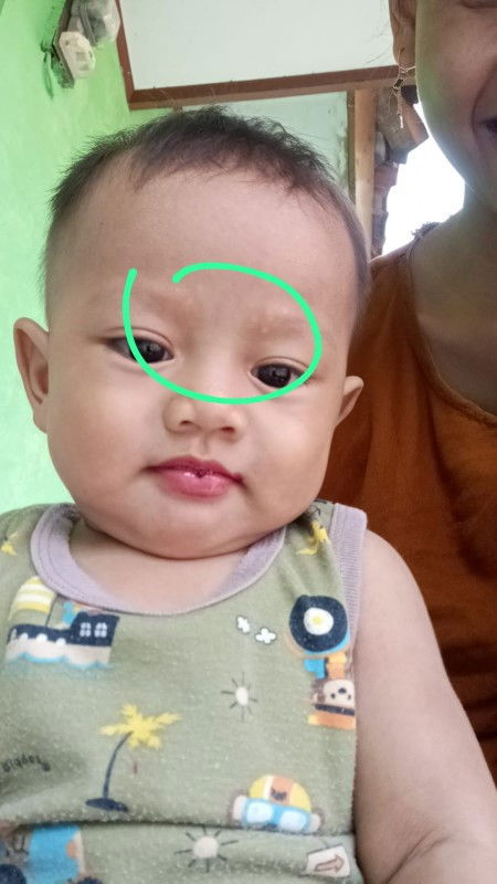Bercak putih seperti panu,