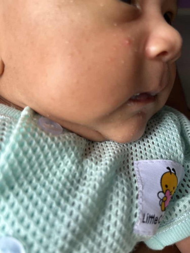 Jerawat kt muka baby