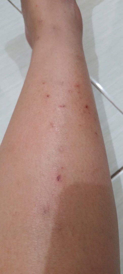 Obat gatal gatal untuk busui