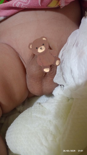 hello po ask lang sana ako kasi nag aalala ako ngayon sa baby ko tatlo po kasi ang testicles nya.