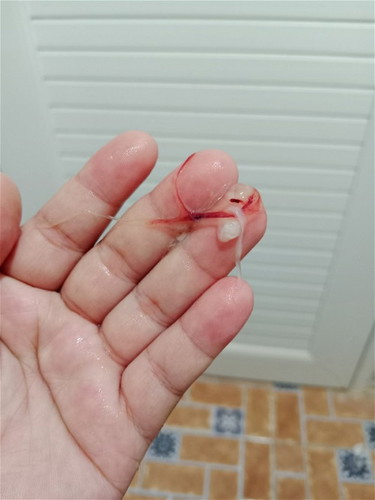 มูกเลือด 38+5