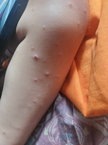 May itchy skin po toddler ko at parang pigsa not really sure. Baka may alam kayo ano to mga my 🥺