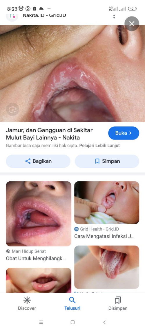 Jamur di bibir bayi