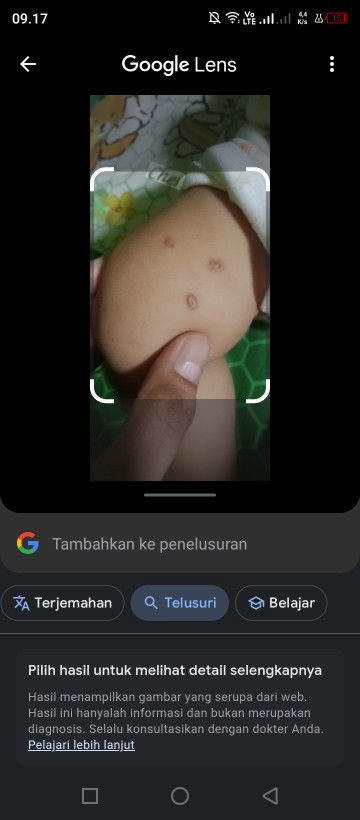 Muncul bentol seperti sundutan rokok