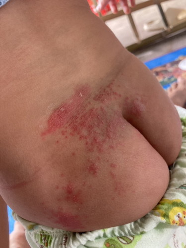 ขอสอบถามหน่อยค่ะลูกเป็นผื่นที่ตูด