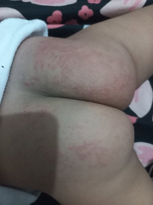 Pantat bayi timbul bintik bintik memerah