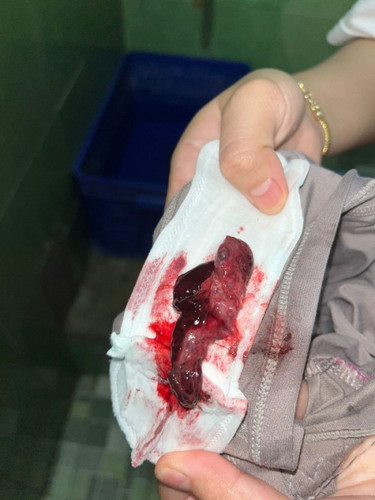 Udh 4 hari keluar darah Bun, sore ini keluar gumpalan. Tapi perut gak nyeri sama sekali Bun