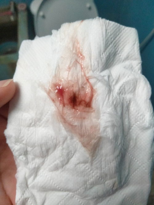 โดนกระตุ้นคลอดท้อง3