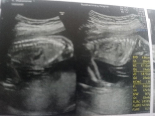 น้องได้22วีคแล้วรอลุ้นเพศค่ะ