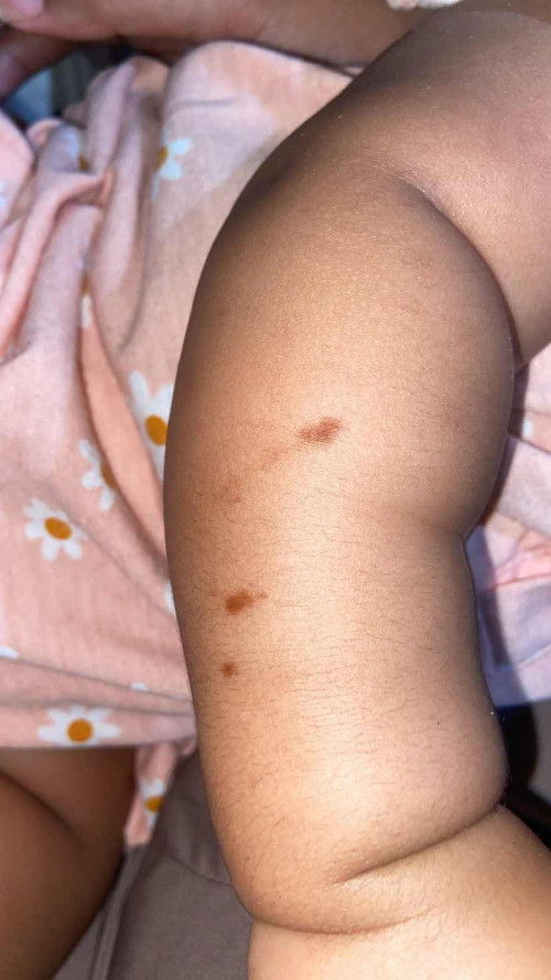 Muncul bercak coklat dikulit bayi tiba2
