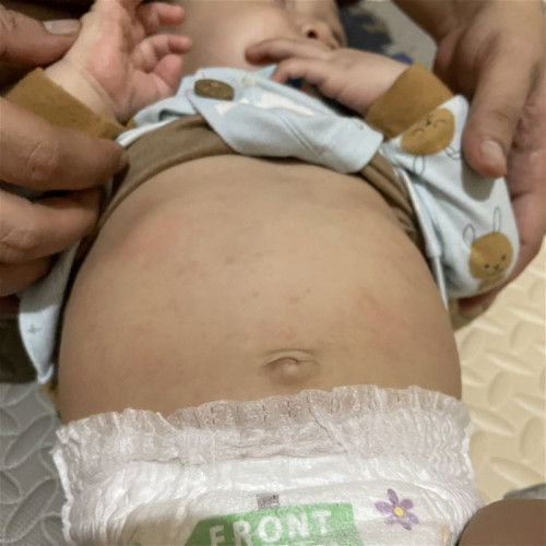 Bercak merah setelah demam