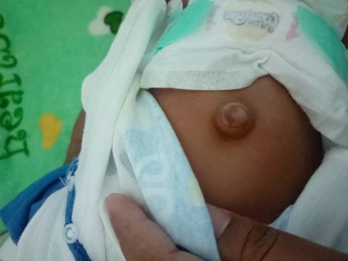 สะดือลูกจุ่นออกมา