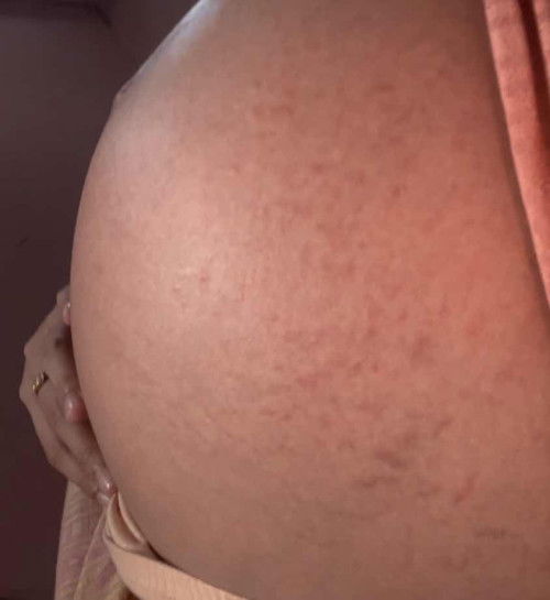 แนะนำครีมทาท้องทีค่ะ