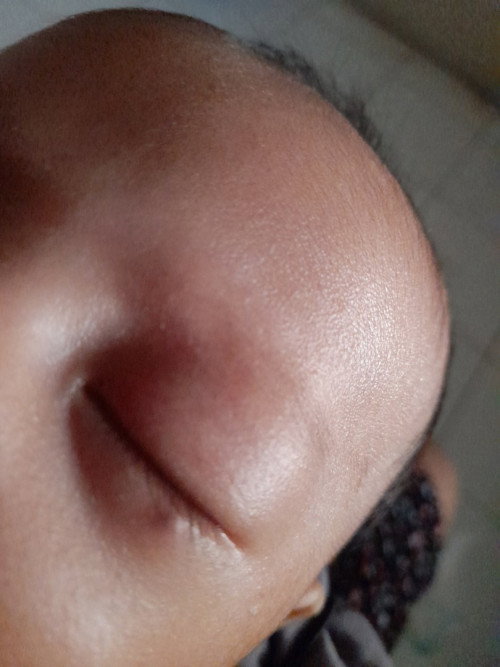 Baby 2 bulan tiba2 muncul benjol kecil di area bawah mata, ada yg tau ini kenapa?