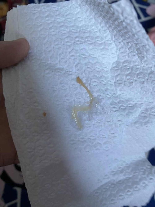 ท้อง2หลังน้ำคาวปลาหมดมีมูกออกมาเเบบนี้ปกติไหม?