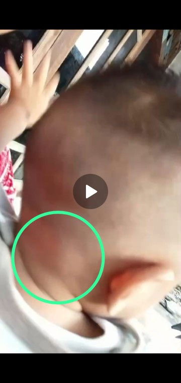 Benjolan pada belakang telinga sebelah kanan