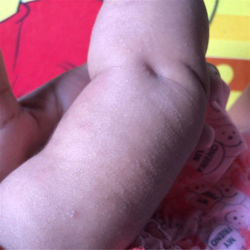 ขึ้นตุ้มเล็กๆตามเเขนขา จะหายใปเองไหมคะ