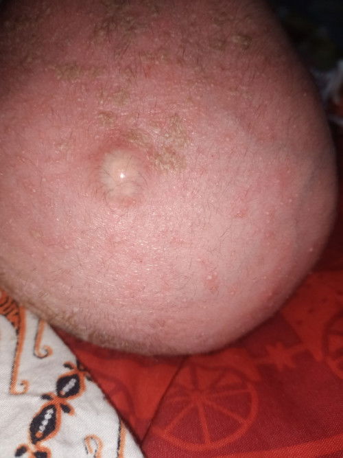 Benjolan bawaan lahir