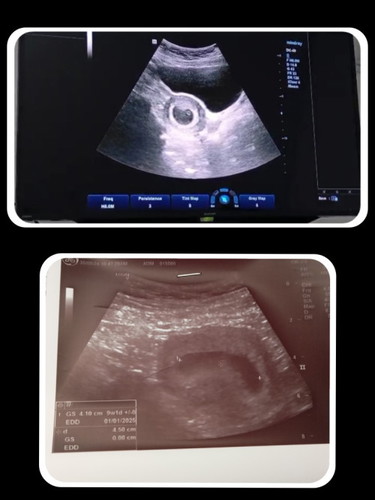 Scan xnampak janin