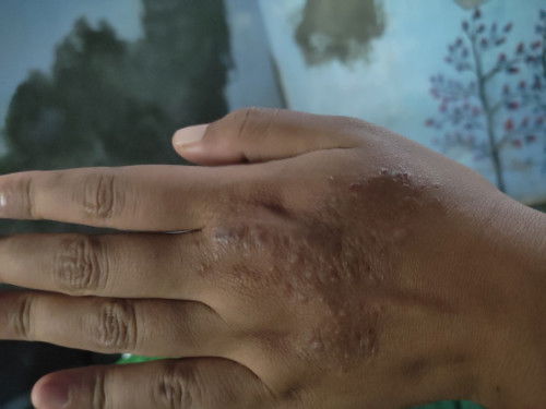 Gatal-gatal sejak trimester 2