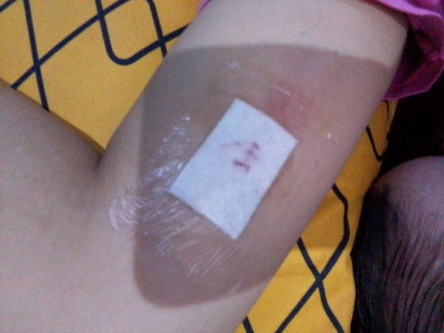 Pasang kb implant