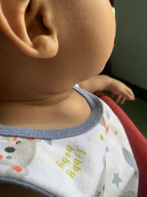 Benjolan dibawah leher atau klavikula