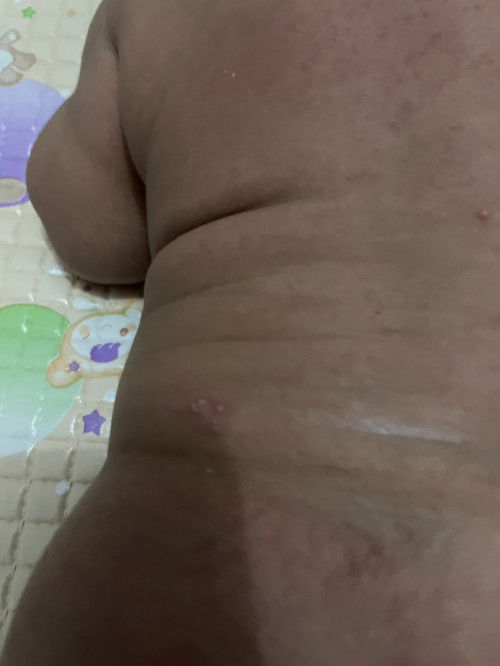 bentol di punggung baby